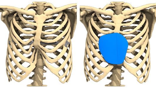 Immagine di pianificazione preoperatoria studiata al computer della ricostruzione con impianto 3D personalizzato