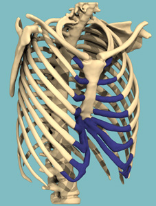 Progettazione 3D di un Pectus Excavatum