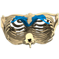 Vue 3D d'un Pectus Excavatum de type 1