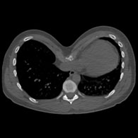 Indice de Haller du Pectus de type 1