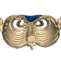 Vue 3D d'un Pectus Excavatum de type 1 avec implant