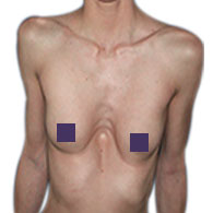 Pectus Excavatum de type 1 chez la femme