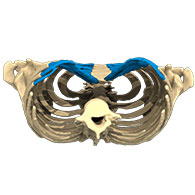 Vue 3D d'un Pectus Excavatum de type 2