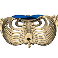 Vue 3D d'un Pectus Excavatum de type 2 avec implant