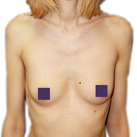 Pectus Excavatum de type 2 chez la femme