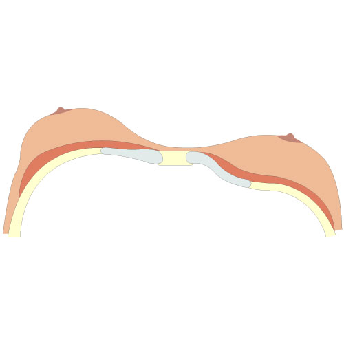 Dessin de Pectus Excavatum de type 3