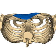 Vue 3D d'un Pectus Excavatum de type 3 avec implant