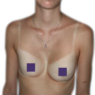 Pectus Excavatum de type 3 chez la femme