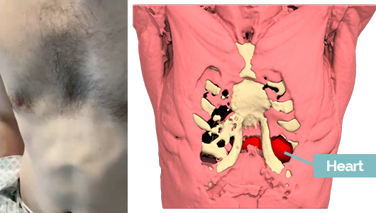 Fracaso de Ravitch para la corrección de un Pectus Excavatum con latido del corazón visible en la vida real y en el diseño 3D