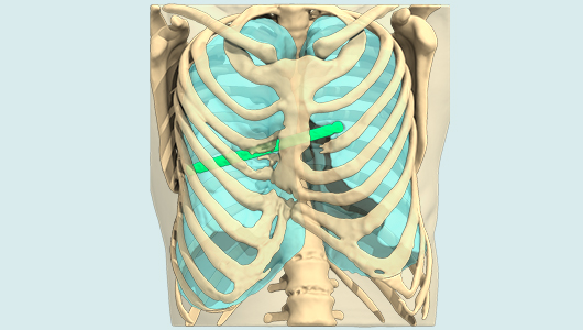 Risk of bar movement from Nuss technique on Pectus Excavatum