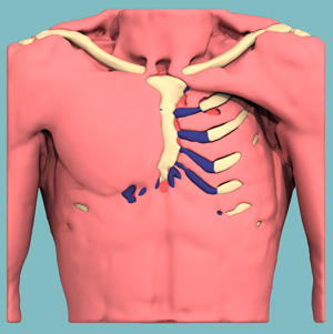 Progettazione 3D di un Sindrome de Poland