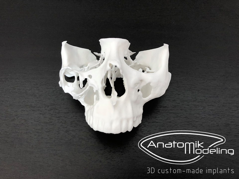 Impression 3D : Nouvelle approche pour anticiper l&#039;acte chirurgical