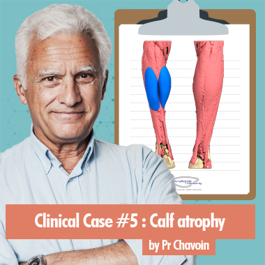 Cas clinique 5 : atrophie des mollets par le Pr Chavoin