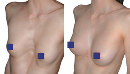 Immagine Prima / Dopo di un Pectus Excavatum in una moglie