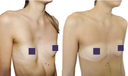 Resultados de pectus excavatum hembra