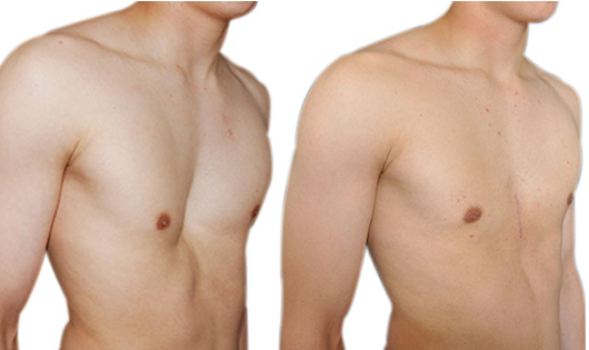 Resultados de pectus excavatum macho