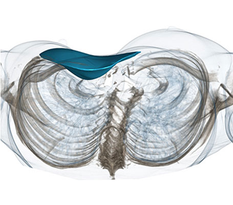 Vista 3D de un Pectus Excavatum con implante