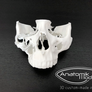 3D printing : New approach for pre surgery planning 