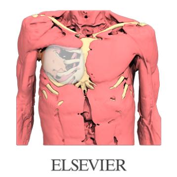 EMC - Syndrome de Poland secondaire après lambeau de latissimus dorsi