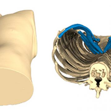 Pectus Excavatum: caso del mes