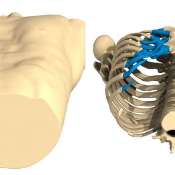 Pectus Excavatum : caso del mes