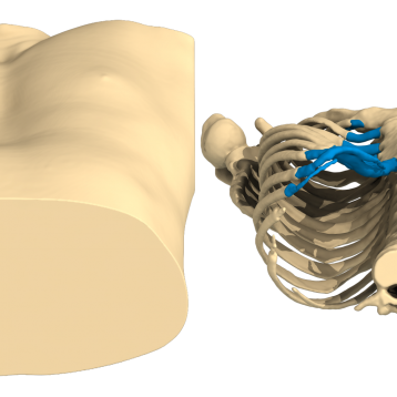 Pectus Excavatum: caso del mes