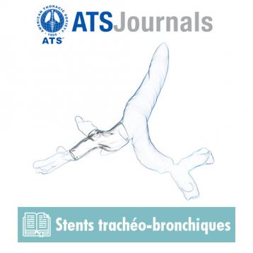 ATS Journal artículo : Computer-assisted Customized Airway Stent 